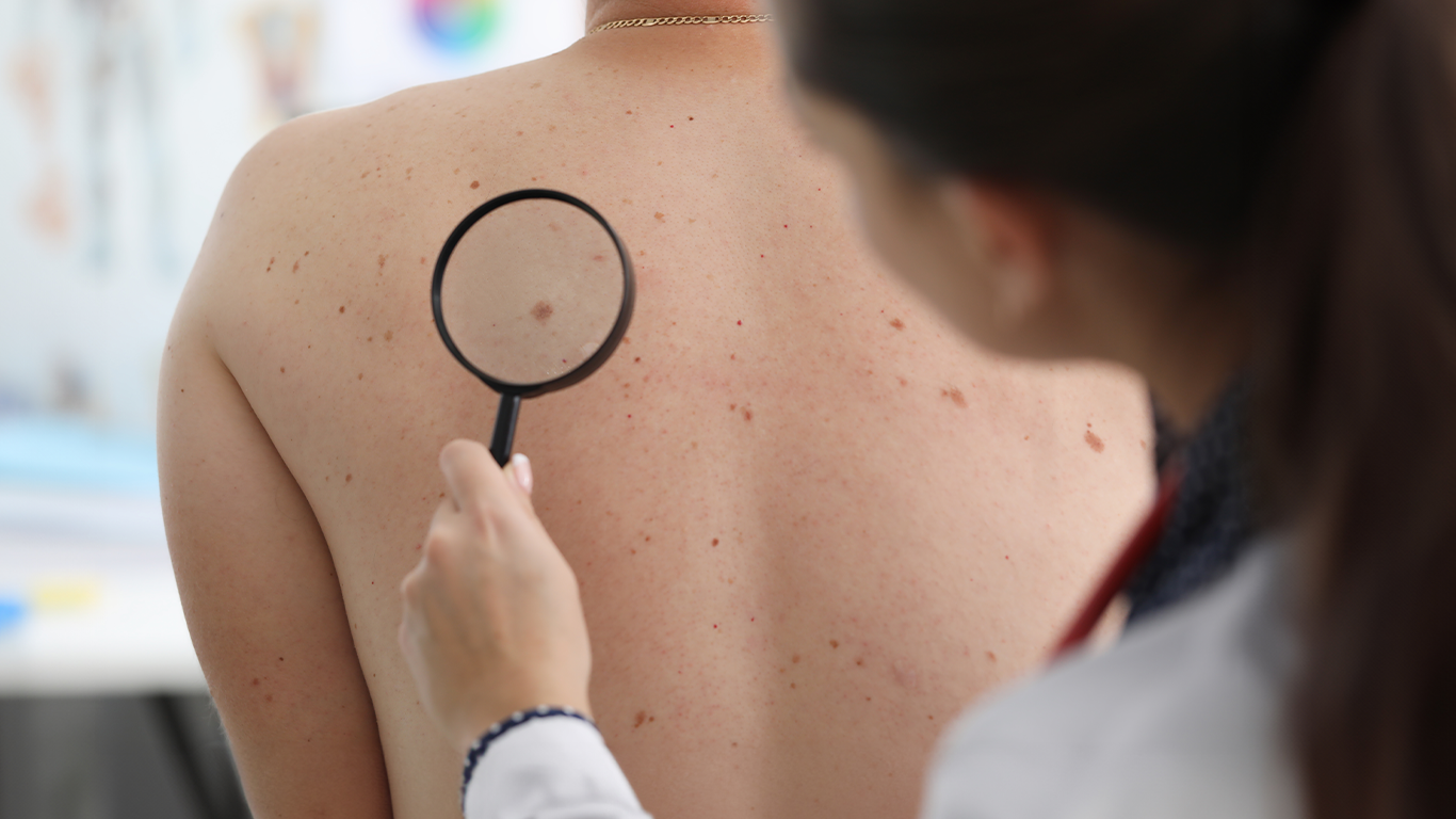 Controllo dei nei e prevenzione: perché non rimandare